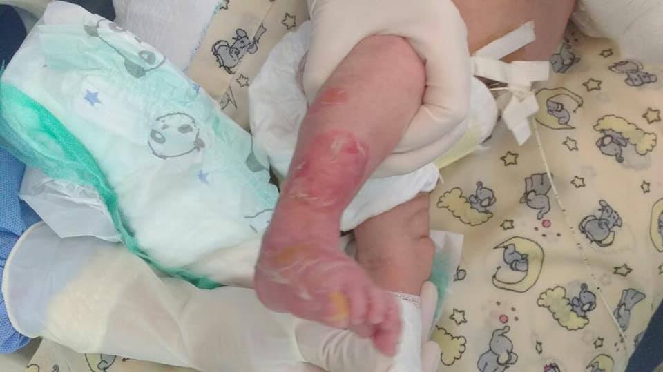 Piden ayuda para un bebé de Luján con piel - Canal 9 Mendoza
