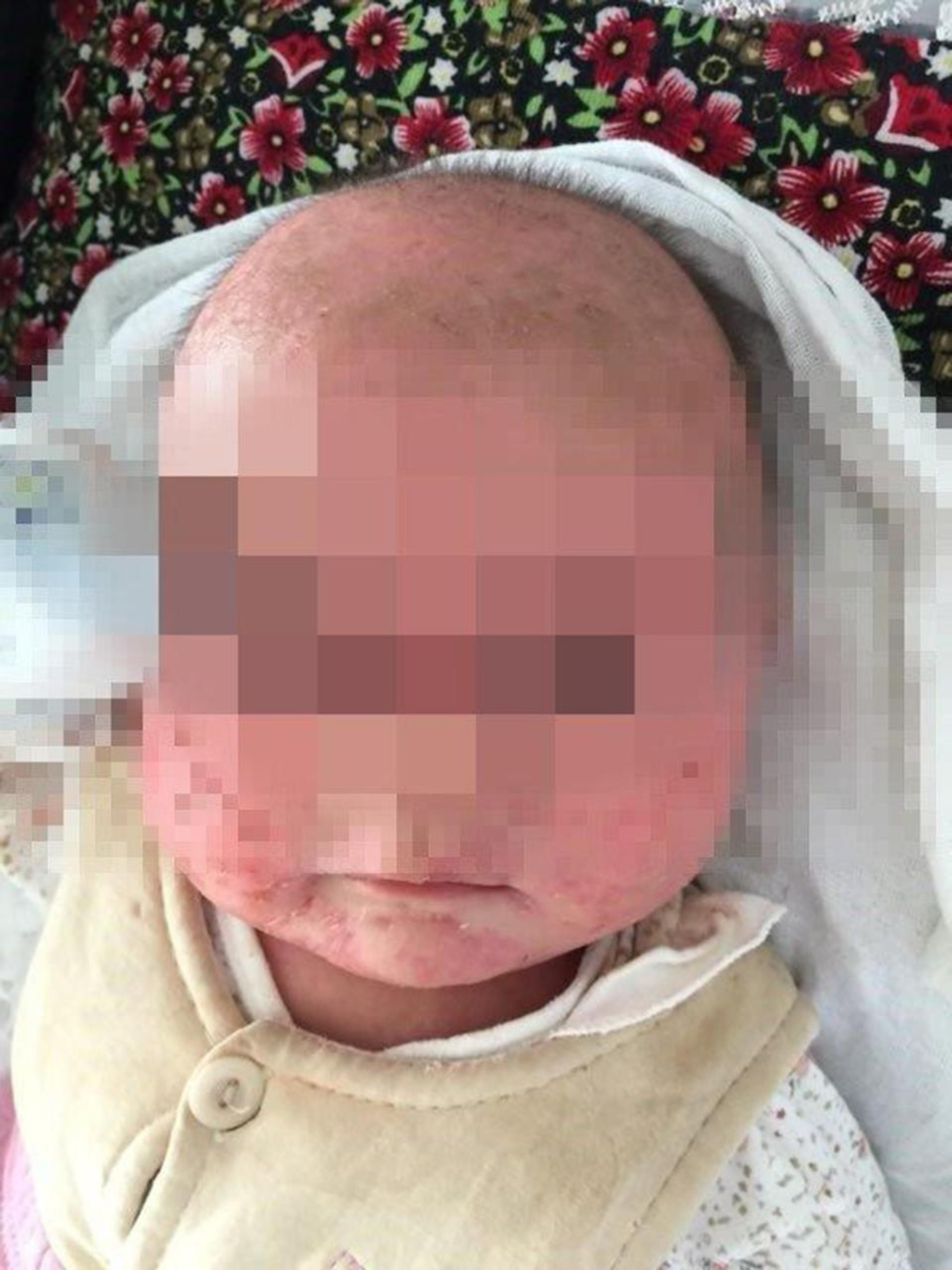 Un Bebe Se Contagio De Herpes Por Los Besos De Su Madre Canal 9 Televida Mendoza